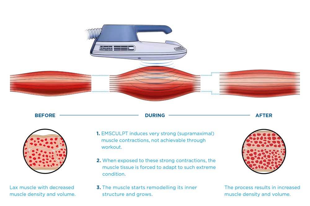 How EMsculpts Works?